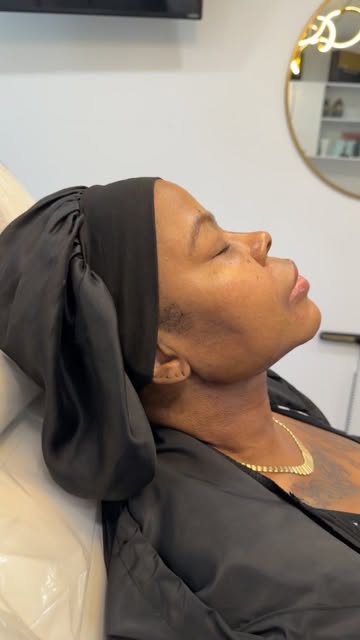 Post up submental liposuction and fat grafting to the face