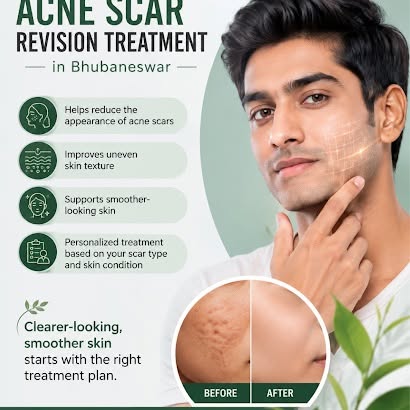Say Goodbye to Acne Scars, Hello to Smoother Skin! 
Acne may fade, but the scars can stay behind. If