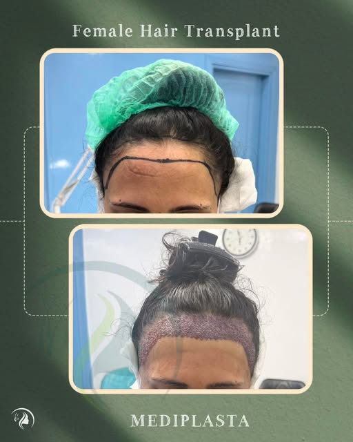 Female patient had done her hair transplant in Our Clinic. She was very happy and satisfied. We also