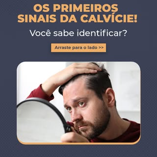 A calvície nem sempre começa quando você percebe uma área sem cabelo.

Em muitos casos, os primeiros