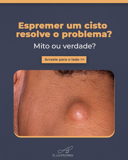 Quase todo mundo já tentou resolver um cisto em casa. E o motivo de continuar voltando não é falta d