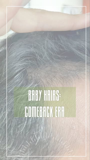 Watching your hairline slowly come back to life ✨
Small changes. New growth. A healthier-looking hai