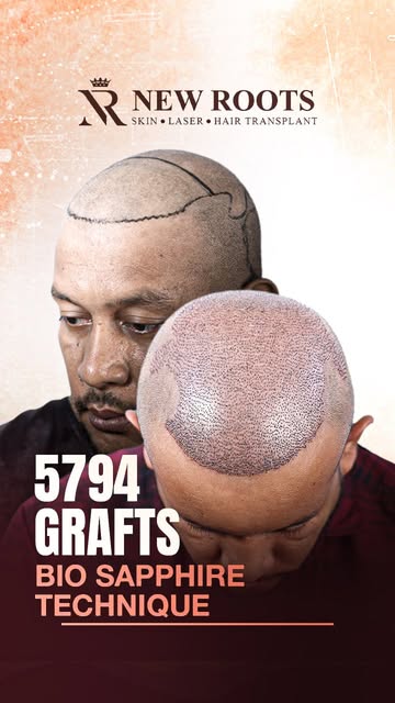 Bio Sapphire | 5794 Grafts | New Roots | Hair Transplant

📍 Visit Our Clinic:
🏥 House 3, Road 17, 
