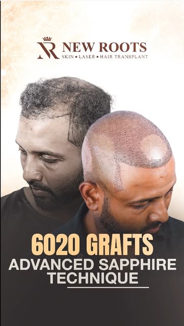 Sapphire | 6020 Grafts | New Roots | Hair Transplant

📍 Visit Our Clinic:
🏥 House 3, Road 17, Bloc