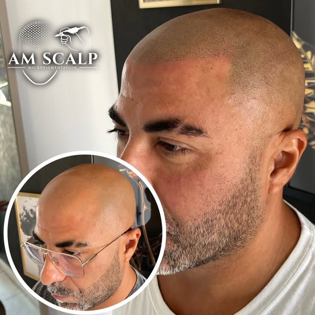 Magnifique résultat 🔥 une nouvelle vie commence ✨✌🏻

Comment en bénéficier ? ⤵️

Avec la tricopigm