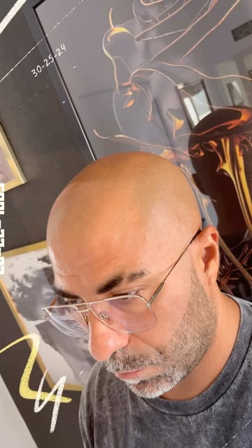 Changer de crâne, c'est changer de style. 💇‍♂️✨
Avec la tricopigmentation effet rasé, c'est toi qui