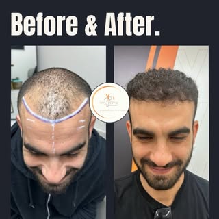 אנחנו יודעים שגם אתם בהלם מזה שמדובר בהשתלת שיער מרוב שזה נראה טבעי 🫠
משיער דליל בחלק הקדמי לשיער מ