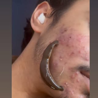 #skin #ayurveda #skindisease #leechtherapy  sometime Funny lyrics jaruri hain😆

Informative????