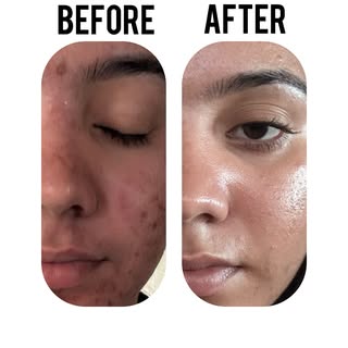Acne defeated. Confidence restored. Ayurveda wins again. 
Clear skin, clear confidence – Ayurveda tu