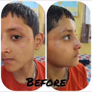 Testimonial of my little patient #fungalinfection #ayurvedatreatment