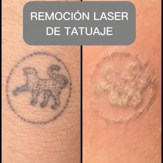 ⚡Dile adiós a los tatuajes que ya no quieres en tu piel. 
✨Con el láser de ND- Yag✨ podemos remover 