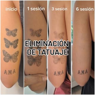 🙌Terminando la eliminación de estos tatuajes, con constancia y paciencia logramos borrar el 95% 💥
