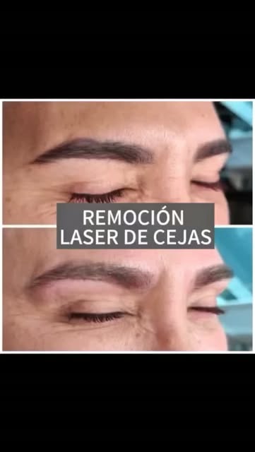 Solución simple, rápida y eficaz para eliminar pigmento indeseado en las cejas. 
En una sesión con n