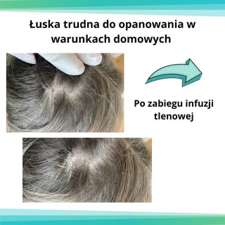 ⭕Infuzja Tlenowa to nieinwazyjny i przyjemny zabieg. 

❎Wykorzystywany jest w nim skoncentrowany tle