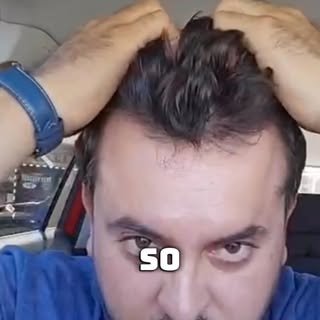 TESTIMONIO de Paciente: ¿cómo es un Injerto Capilar con nosotros? Resultados de Injerto: #injertocap