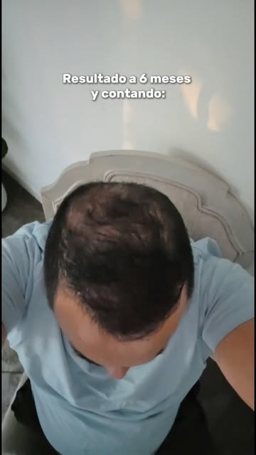 RESULTADO a 6 MESES de procedimiento de Injerto Capilar! 

#injertocapilar #hairtransplant #resultad