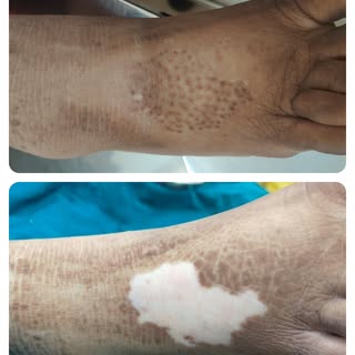 Vitiligo can be treated. This lady with a stable vitiligo was treated with mini punch grafting. And 