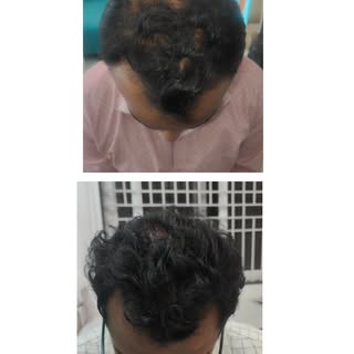 Results of Growth factor concentrate!
Not dramatic, but definitely satisfying. The hairs have become