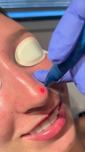 Redness, meet your match. 👋

Diolite laser can target visible blood vessels and facial redness for 