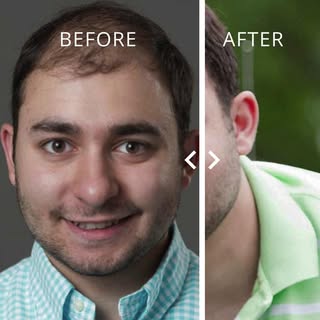 Men's Hair replacement can have a dramatic effect on the hair loss. Reclaim your confidence, get you