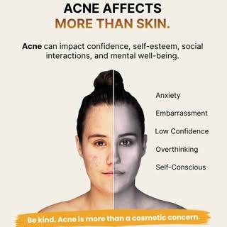 Acne is more than just a skin condition—it can affect confidence, self-esteem, social interactions, 