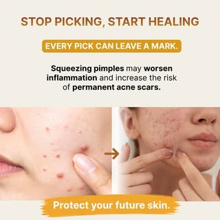 🚫 Stop picking. Start healing. 💛

It may feel tempting to squeeze a pimple, but every time you pic