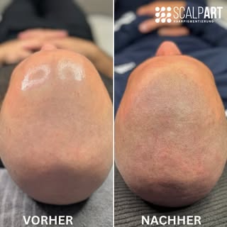 Hol dir deine Haarlinie zurück! 🤩
________________________________________________
#smp #scalpmicro