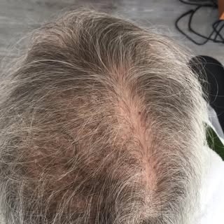Pose d’un volumateur au micro fil
