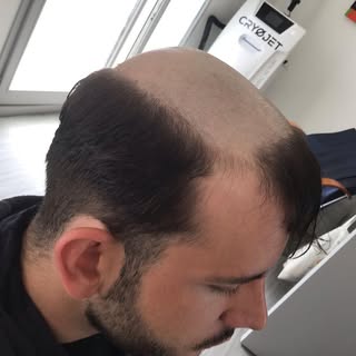 Pose d’un complément capillaire homme avec coupe