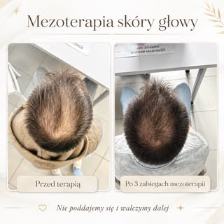 3 zabiegi mezoterapii mikroigłowej skóry głowy za nami 💉

Pierwsze efekty już widać, ale na tym eta