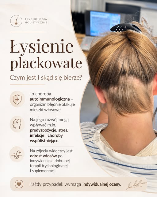 Łysienie plackowate - kiedy włosy zaczynają wracać ❤️

Łysienie plackowate to choroba o podłożu auto