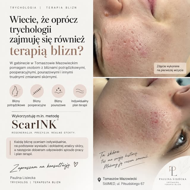 Wiecie, że oprócz trychologii zajmuję się również bliznami?

Wczoraj trafiła do mnie klientka z bliz