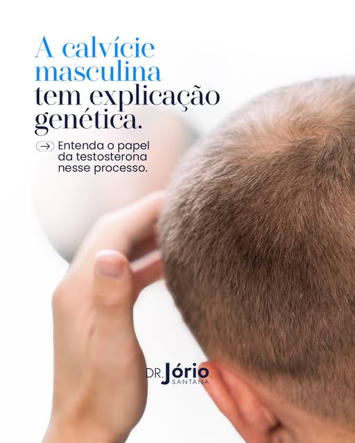 A queda de cabelo masculina, na maioria dos casos, tem origem genética. A conversão da testosterona 
