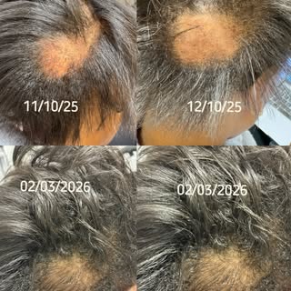 ✨✨✨ Transformation Tuesday ✨✨✨ 
Your immune system is your protection system.

When it becomes overa