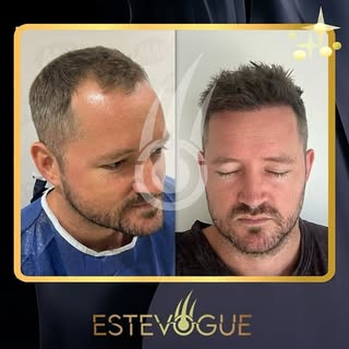 🇬🇧 FUE treatment provides a natural hairline, maximum coverage and amazing results in a shortest c