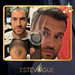🇬🇧 Did you know that most people lose 50% of their hair before they realise they have hair loss 💇