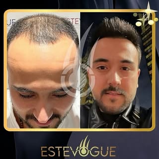 🇬🇧 It is possible to look younger thanks to hair transplantation!💉👌
Here is the stunning change 