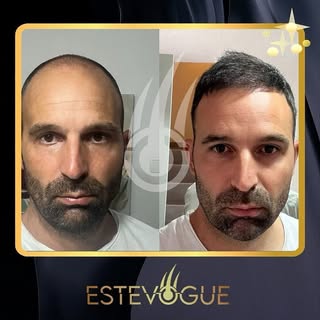 🇬🇧 Are you ready for a wonderful hair transplant experience with EsteVogue?💯💥💉
Here is our pati