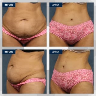 Dr. Boynton’s tummy tuck approach is designed to treat the abdomen comprehensively by addressing the
