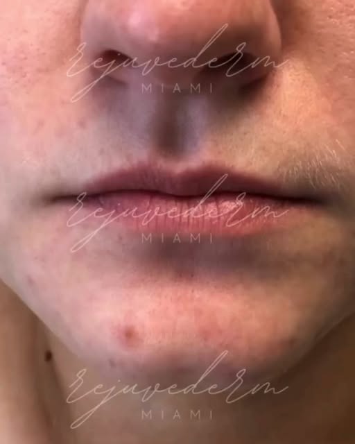 This beautiful young woman contacted us on Yelp looking for fillers. We prefer to offer a more natur