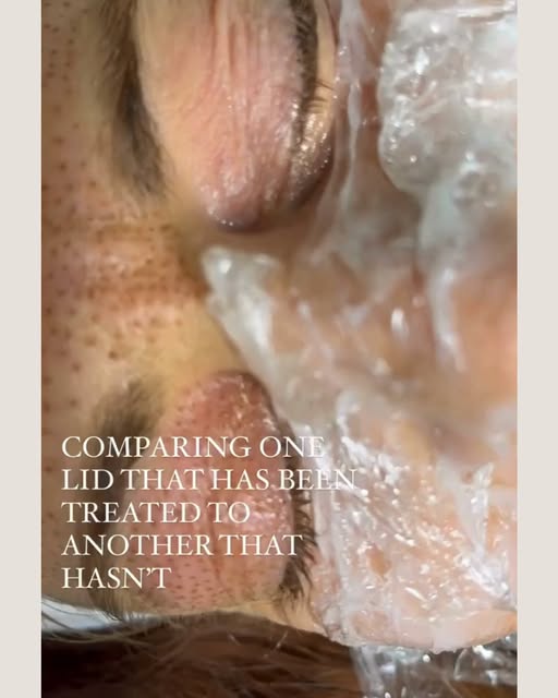 This is mid-session, so the dots you see are the treatment, not the result. The lift shows up as the