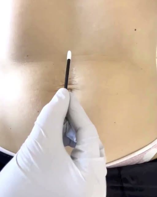 Taking this beauty back to 1996 before babies 💫

No tummy tuck or lasers needed. Plasma Fibroblast 