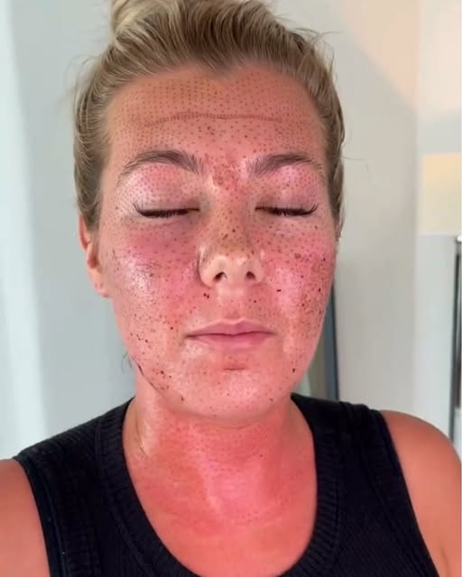 Why would someone get this treatment in their 20’s? And, what are those weird patches on her cheeks?