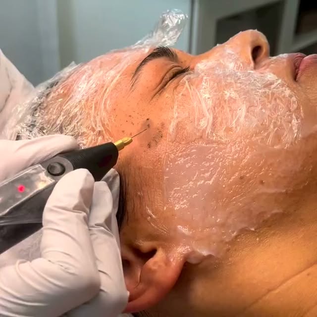 Did you know that fibroblast plasma can treat sun and age spots?

#plasmafibroblast #fibroblastear #
