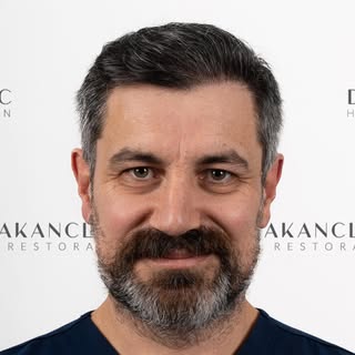 As the first outcome of the new year, I wanted to share my own hair transplant results, which I unde