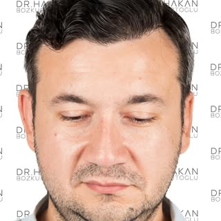 I’m happy to share the 9-month results of our patient whose procedure involved 4500 grafts, allowing