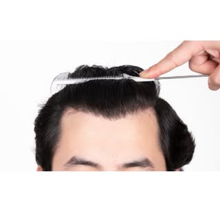 A great example showing why large areas of hair loss are best approached in two separate sessions.
.