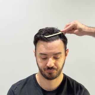 I’m sharing the 9-month results of this partially shaved frontal hair restoration performed using 28