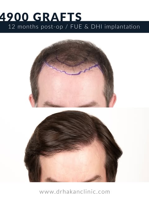 For patients with sufficient donor capacity, I have always considered fine hair to be a very suitabl