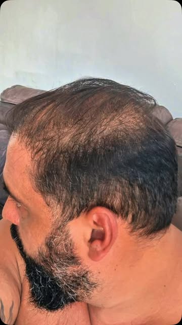 Mais um resultado que fala por si. 🔥

Naturalidade, densidade e uma linha frontal pensada nos mínim